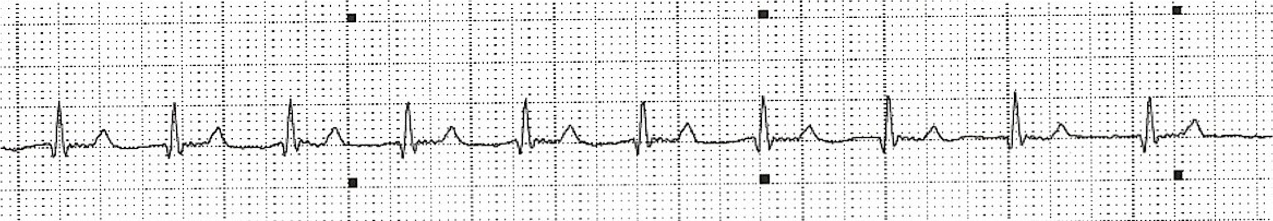 ECG